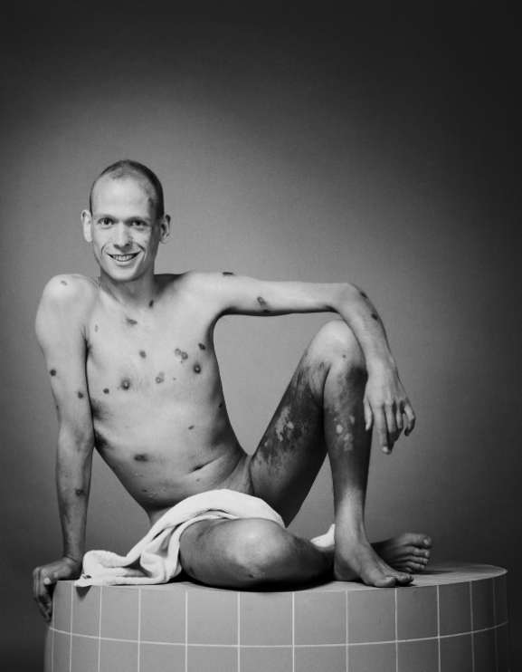 De zichtbare vlekken op Martins huid als gevolg van aids, symbool voor het stigma en de openheid in de podcast.